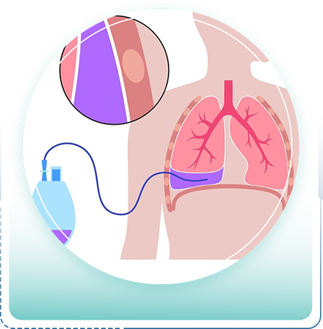 Chest Drain Procedure in Ballari