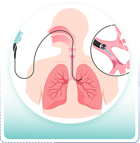 Thoracoscopy in Ballari
